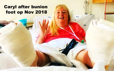 Bunion Foot Surgery: Pros, Cons and Why I finally did it!