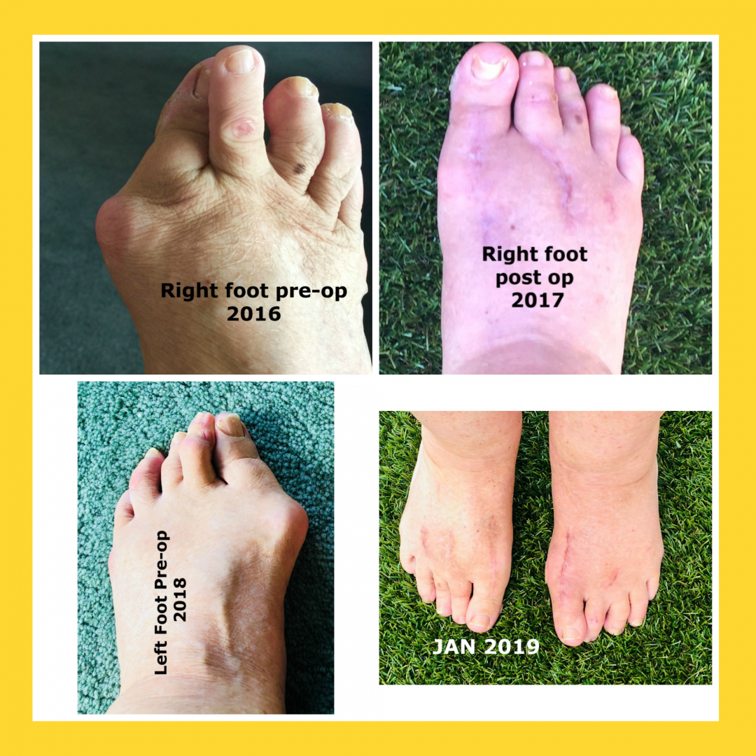Bunion Foot Surgery Pros, Cons and Why I finally did it! Caryl Westmore